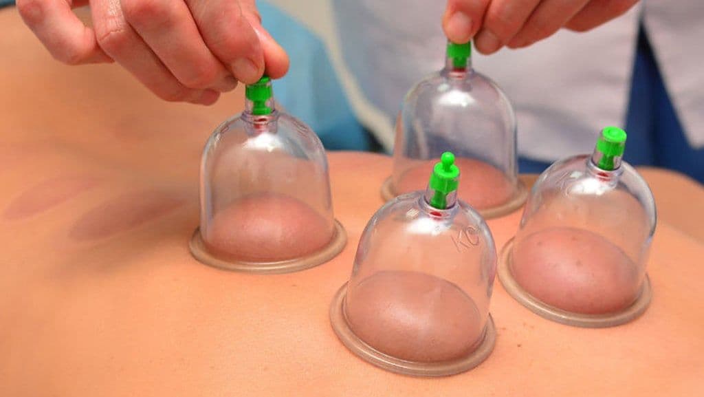 Bekam atau Hijama