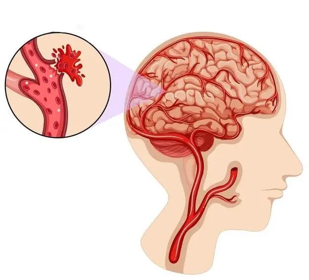 Squalene: Senyawa Laut Penjaga Kesehatan Pembuluh Darah dan Mencegah Stroke